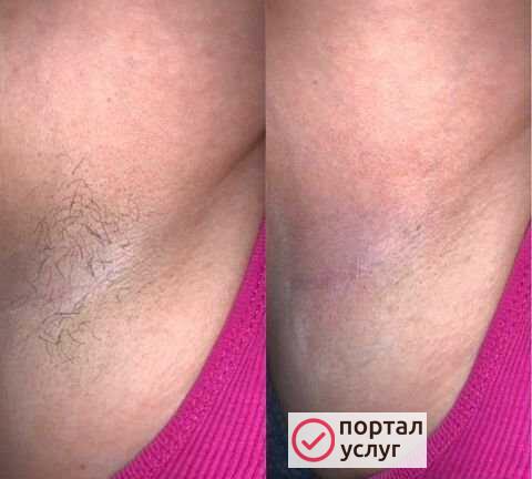 Фото Шугаринг