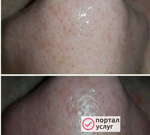 Фото Уз чистка лица