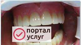 Фото Съемные протезы