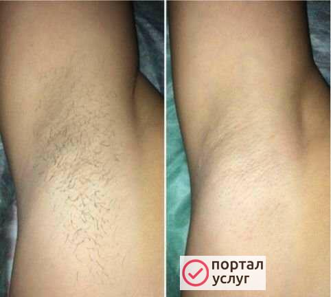 Фото Шугаринг