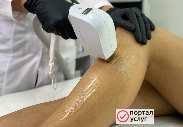 Фото эпиляция 