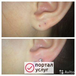 Фото Прокалование ушей
