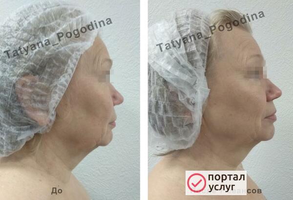 Фото Лифтинговый массаж лица