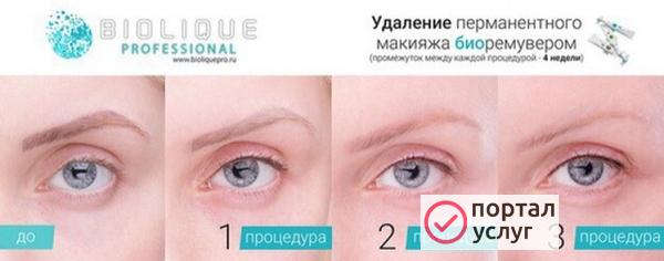 Фото Биоремувер. Удаление татуажа. 
