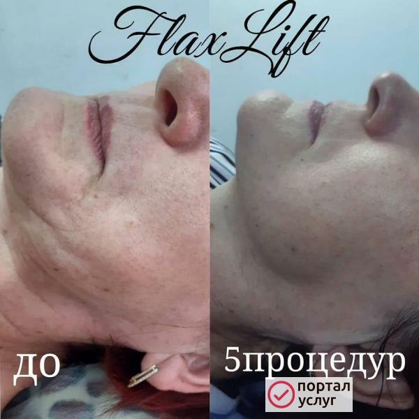 Фото Эстетическое омоложение лица