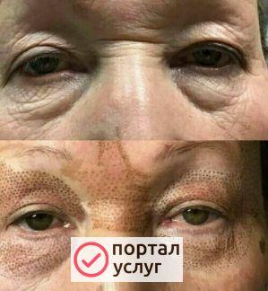 Фото Омоложение без инъекций