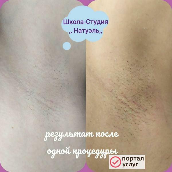 Фото Лазерная Эпиляция.