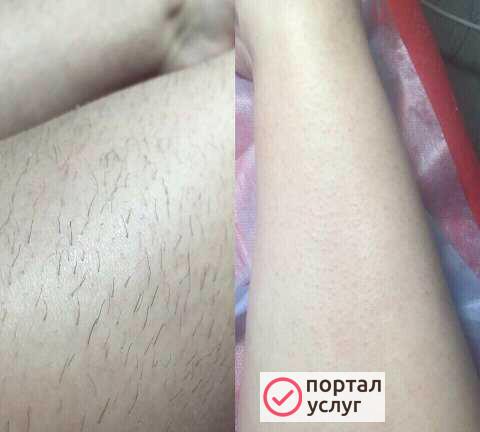 Фото Шугаринг.Депиляция