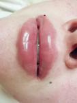 Аугментация губ 