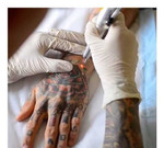 Удаление татуировок и татуажа