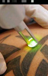 Удаление татуировок(лазерное)