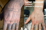 Лазерное удаление тату (перманентного макияжа)