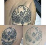 Удаление татуировки неодимовым лазером