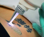 Удаление татуажа и татуировок лазером