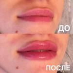 Увеличение губ коррекция асимметрии губ
