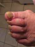 Проблемы стопы и ногтей