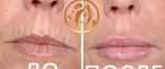 Лечение кисетных морщин (создание четкого контура губ)